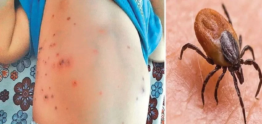 स्क्रब टाइफस बुखार के लक्षण और बचाव
